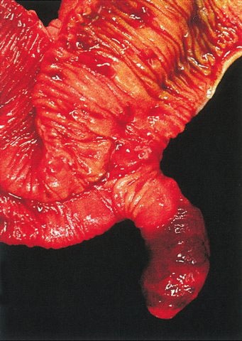 File:Meckel's Diverticulum AFIP.jpg