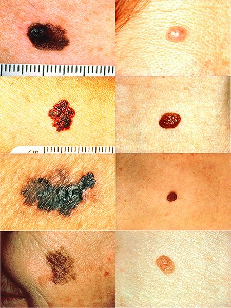 File:MelanomavsNormal.jpg