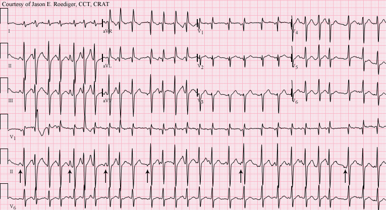 File:Multifocal atrial tachycardia - MAT.png