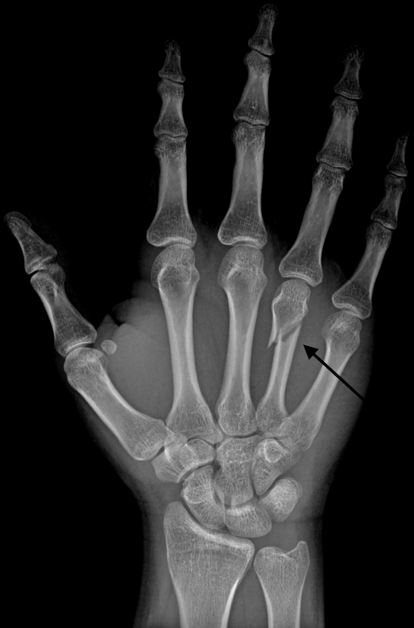 Boxer's Fracture