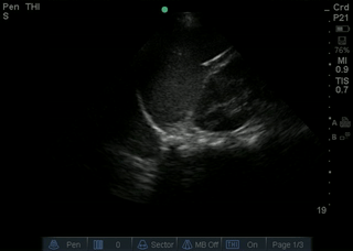 File:No pleural effusion.gif