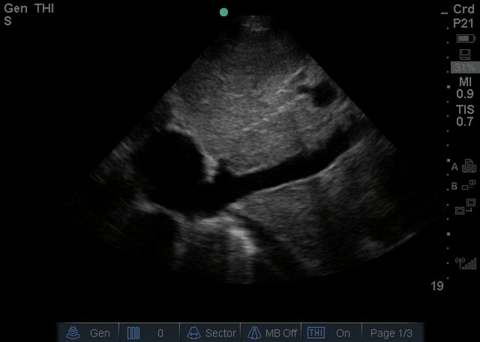 File:Normal IVC.gif