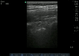 File:Normal lung sliding.gif