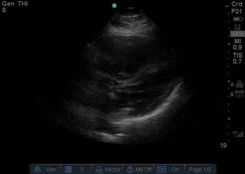 File:Normal subxiphoid.gif