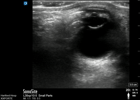File:Ocular - Pupil and Lense on US.gif