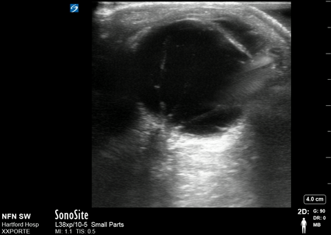 File:Ocular - Retinal detachment and vitreous hemorrhage.gif