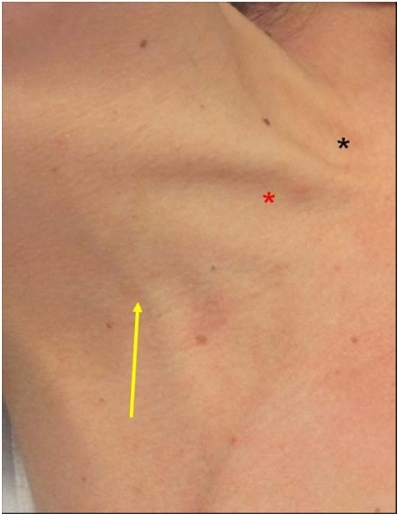 Veiw of right side of anterior neck. External jugular vein is crossing the posterior border of sternocleidomastoid (arrow), Sedillot’s triangle (red star), and sternal notch (black star).