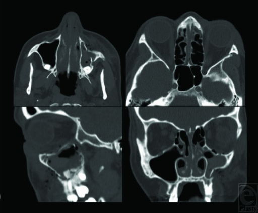 File:PMC4145677 eplasty14ic27 fig1.png
