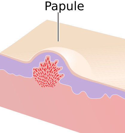 File:Papule.png
