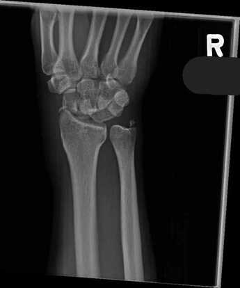 File:Perilunate dislocation.jpeg