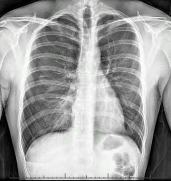 File:Pneumothorax.jpeg