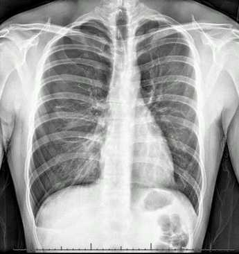 File:Pneumothorax.png