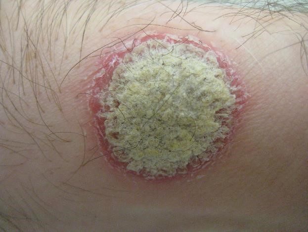 File:Psoriasis2010.jpg