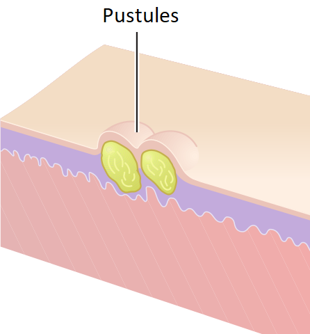 File:Pustules.png