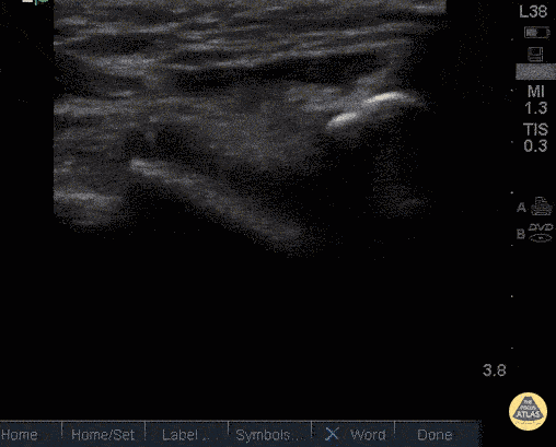File:Quad Tendon Rupture.gif