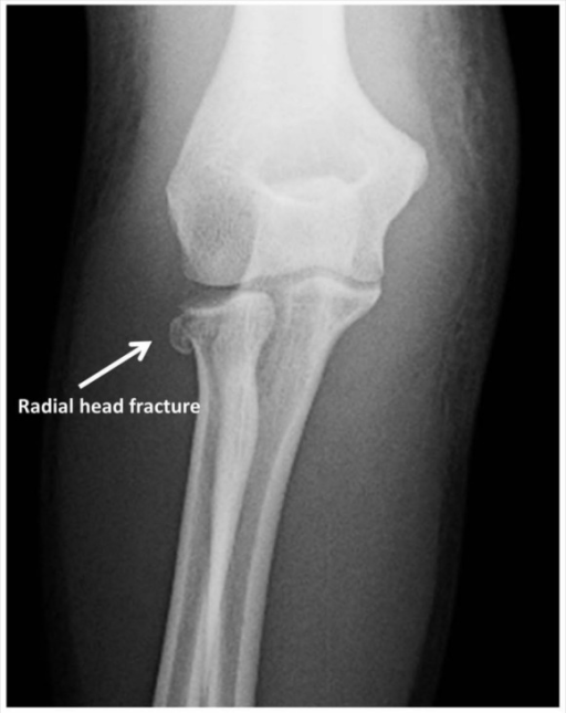 Radial head fracture (peds) WikEM