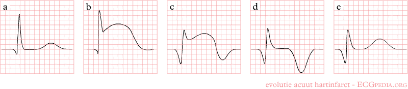 File:STEMI evolution.png