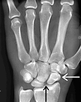 Scapholunate Dissociation.jpg