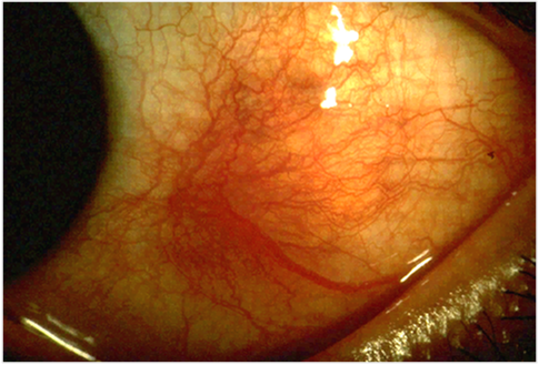 File:Scleritis.png