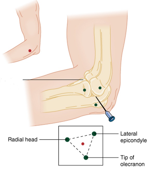 Shoulder Arthrocentesis.jpg
