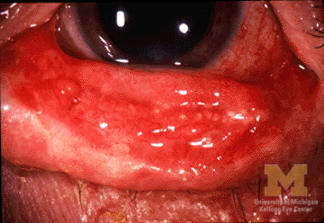 File:Stevens-Johnson Syndrome Conjunctivitis.jpg