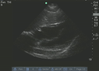 File:Subxiphoid (Still).gif