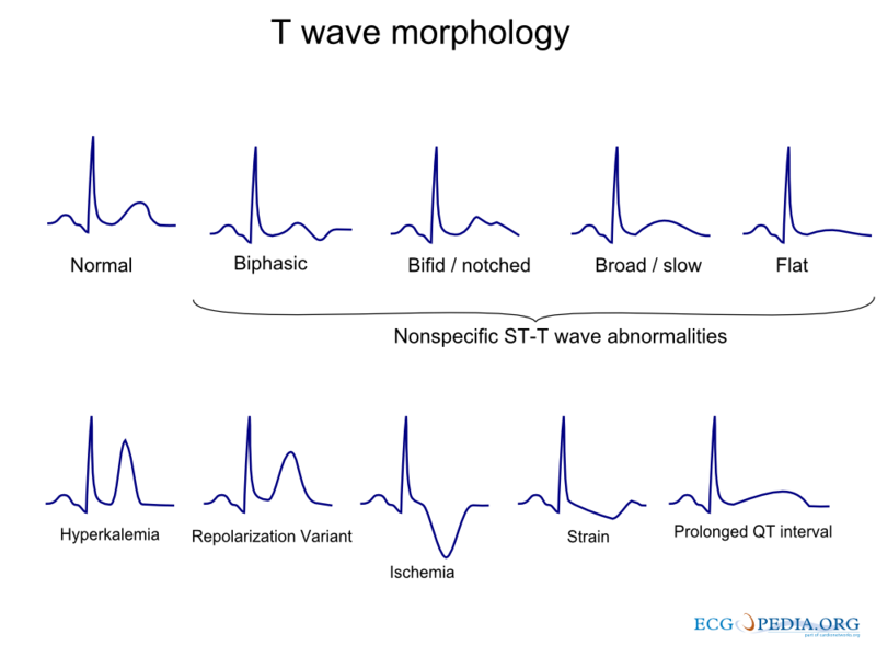 File:T wave morphology.png