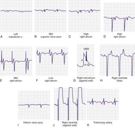 File:Transvenous EKG.jpg
