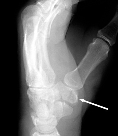 Trapezium Fracture.jpg