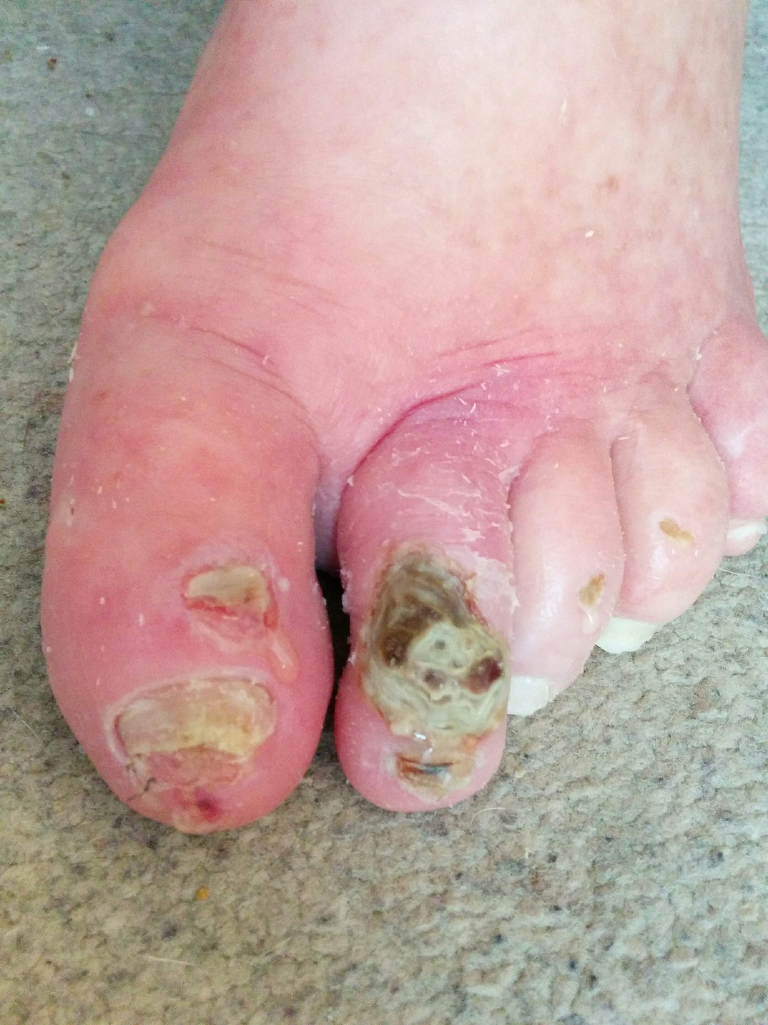 Two ischemic ulcers: second toe (large) and first toe (small).