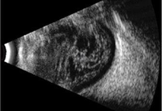 File:Vitreous hemorrhage.jpg