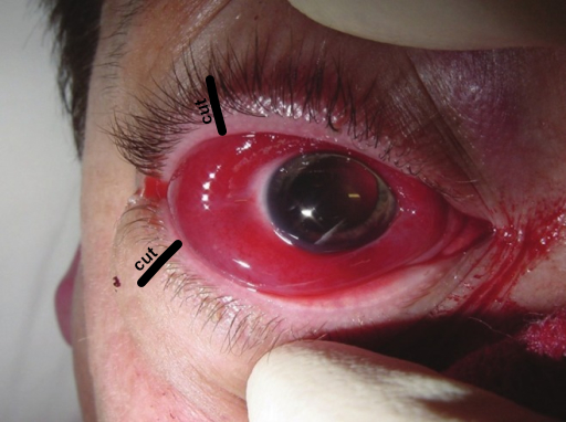 File:Wikem vertical lid split.jpg