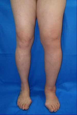 1lymphedema.png