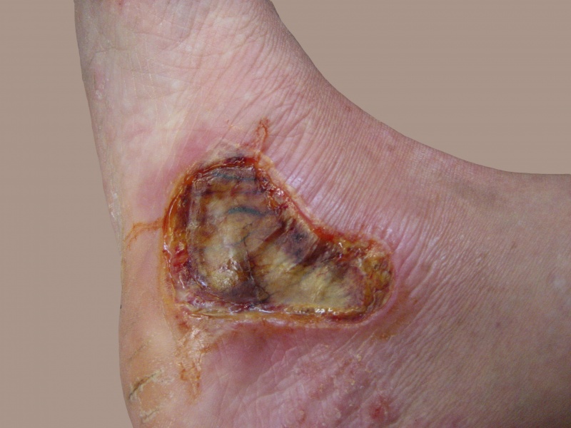 File:8-day-old-3rd-degree-burn.jpg
