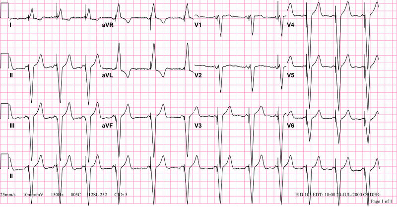 File:A-sense-v-pace-ecg.jpg