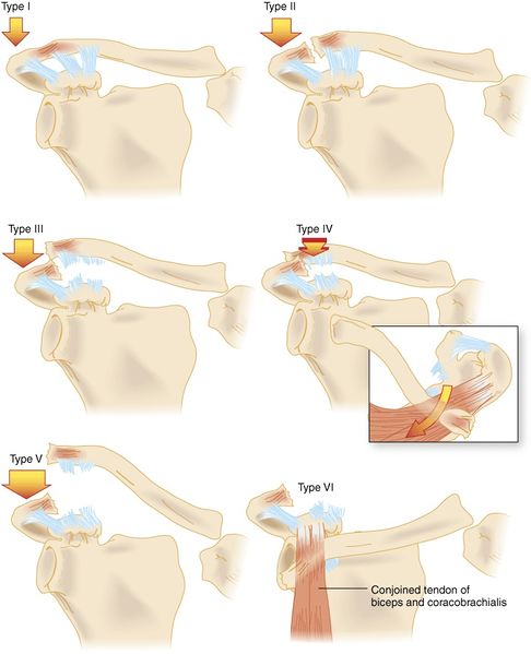 File:AC Joint Separation.jpg