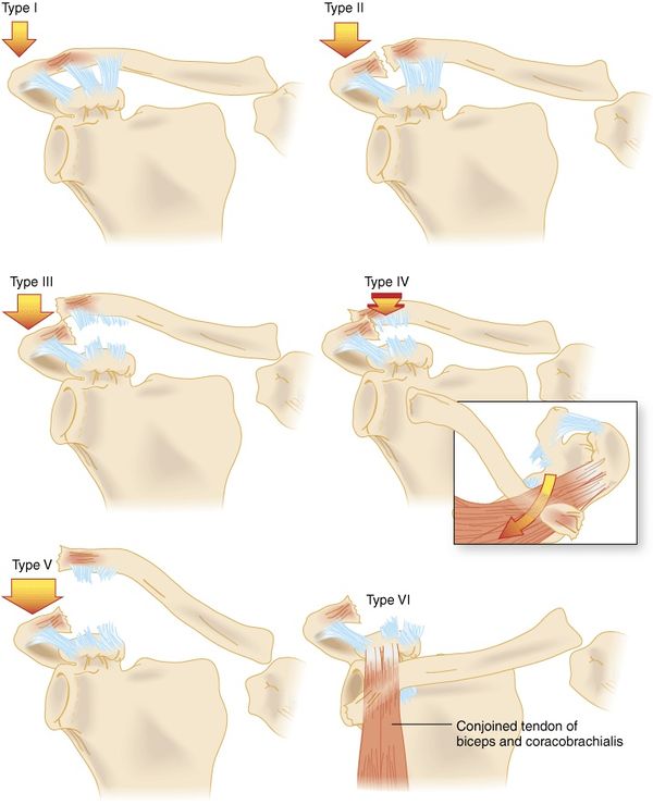 Acromioclavicular joint injury WikEM