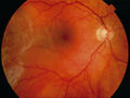 A Retinal Detachment.jpg