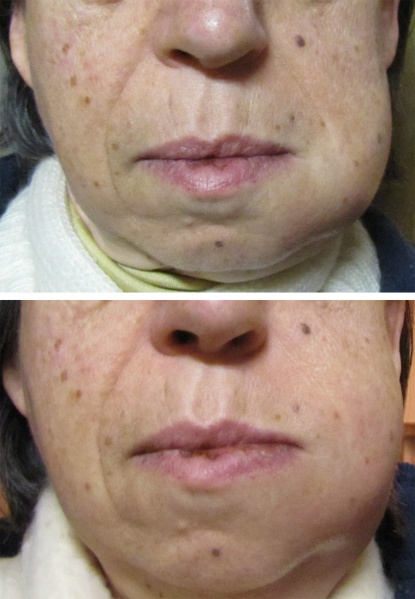 File:Abces dentaire.jpg