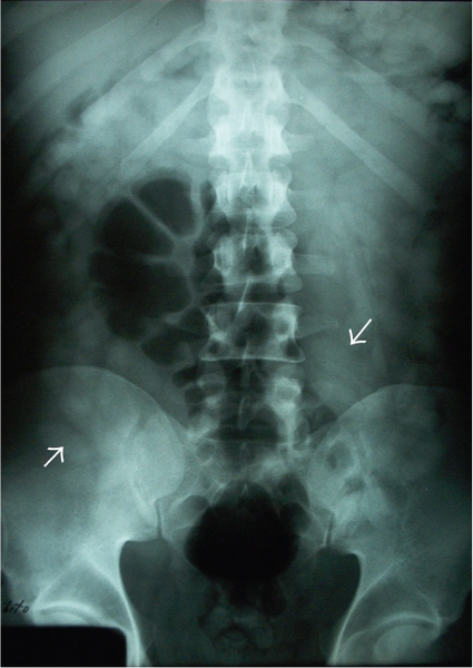 File:Abdominal foreign body.png