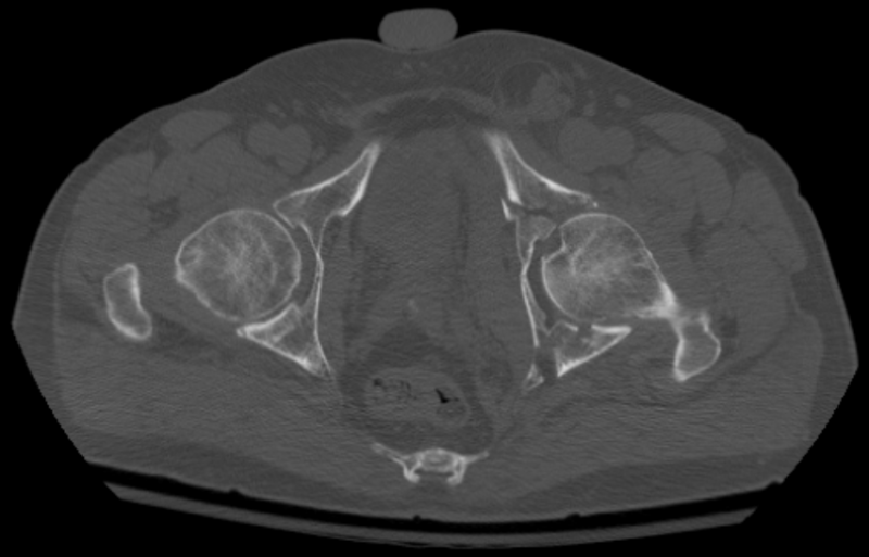 File:Acetabular Fracture CT.png