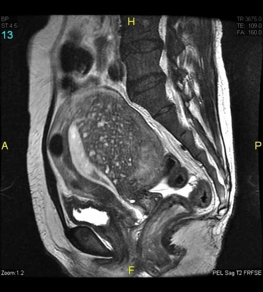 File:Adenomyosis MRI.jpg