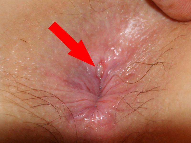 File:Anal fissure 2.jpg