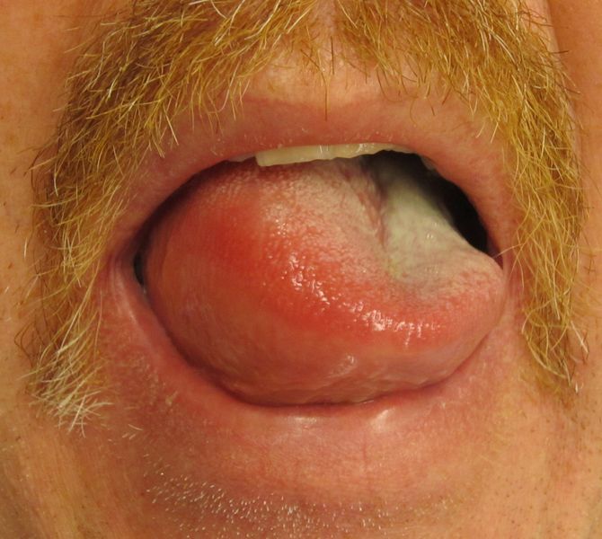 File:Angioedema2013.jpg