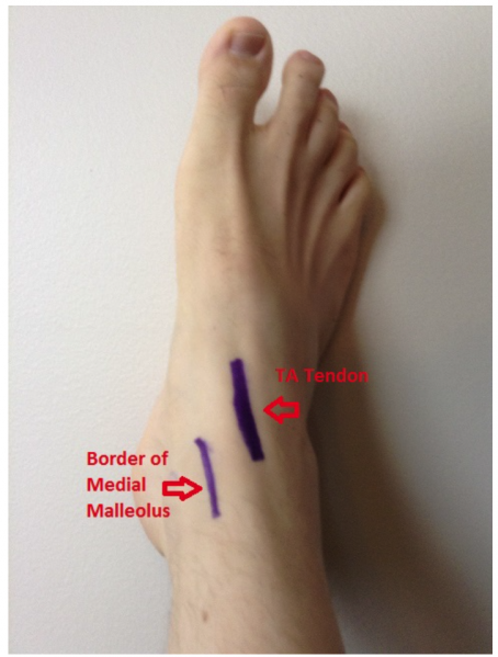 File:Ankle anatomy arthrocentesis.png