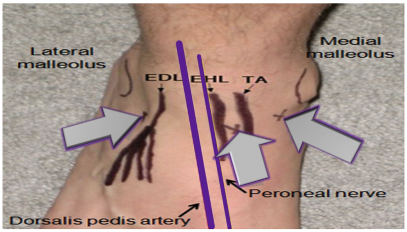 File:Ankle arthrocentesis.png