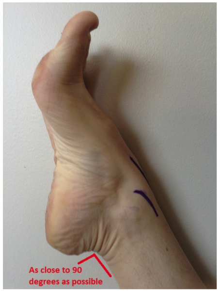 File:Ankle arthrocentesis positioning.png