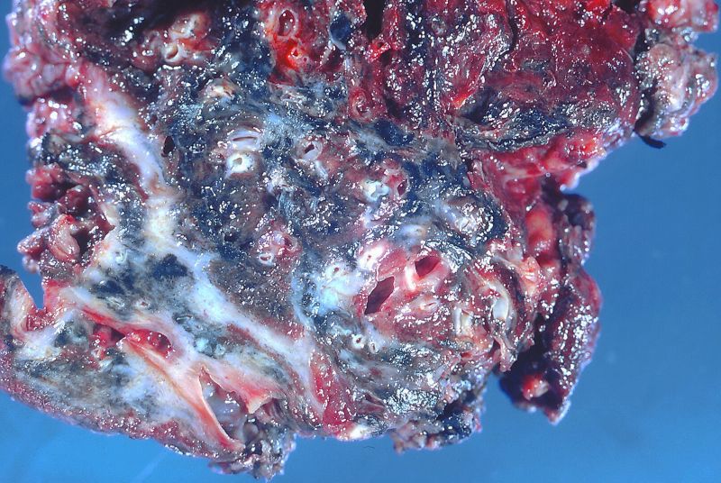 File:Asbestosis (7468458838).jpg