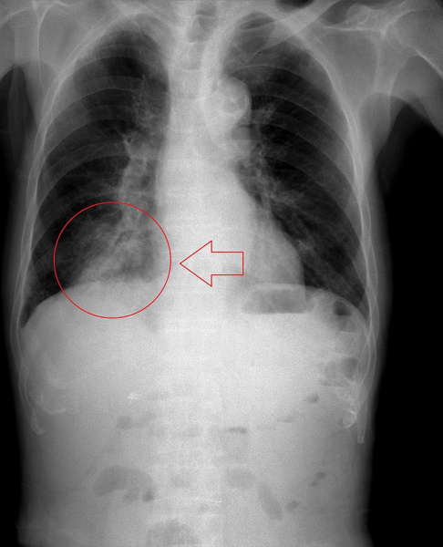 File:Aspiration pneumonia201711-3264.jpg