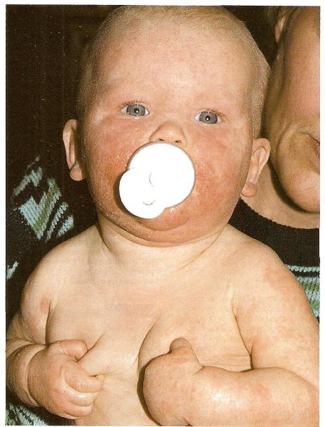 File:Atopic dermatitits.jpg